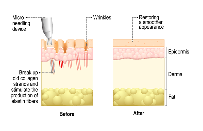 Infographic visualizing how microneedling works
